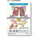 3D Lung Tumor Chart